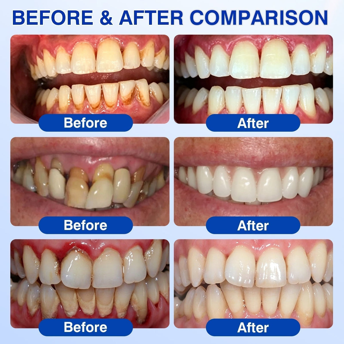 🛡️BBOJI®DenPerm Cavity-Repair Natural Enamel Filling Gel