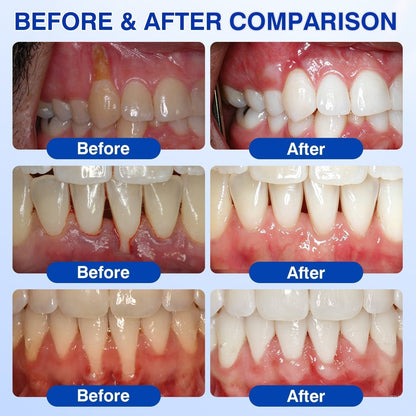 🛡️BBOJI®DenPerm Cavity-Repair Natural Enamel Filling Gel