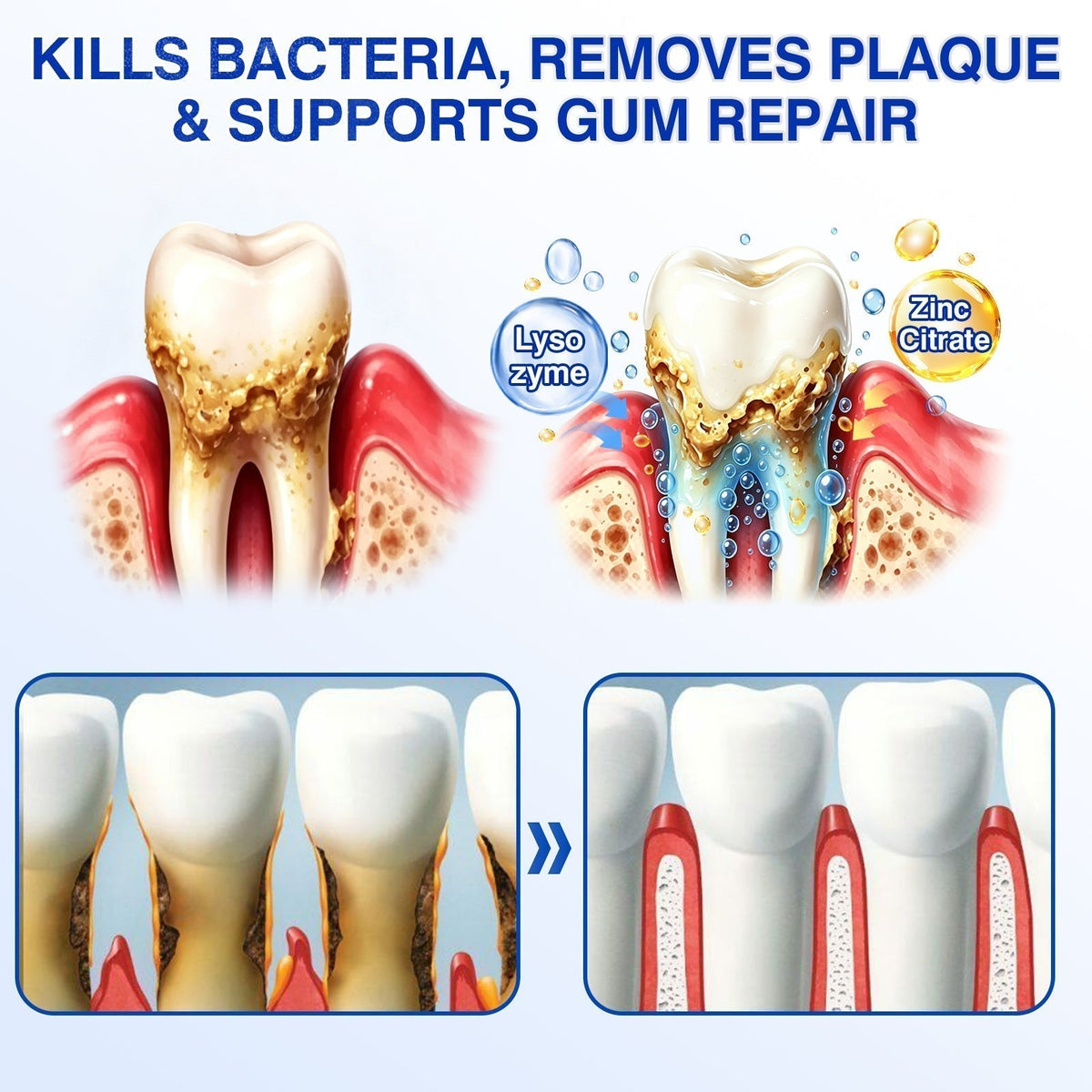 🛡️BBOJI®DenPerm Cavity-Repair Natural Enamel Filling Gel