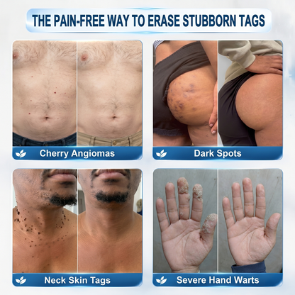 Divifit® Focused Care for Skin Tags & Spots.