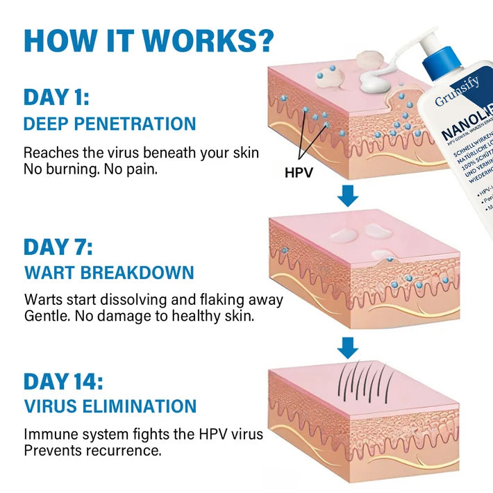 ✅ Official Store:  🔥Grunsify NanoLipo HPV Genital Warts Eraser Cream Plus+