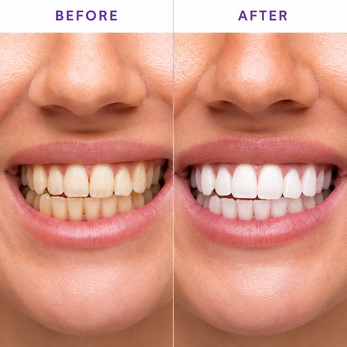 Whitening Strips-Dental Cleaning Marvel